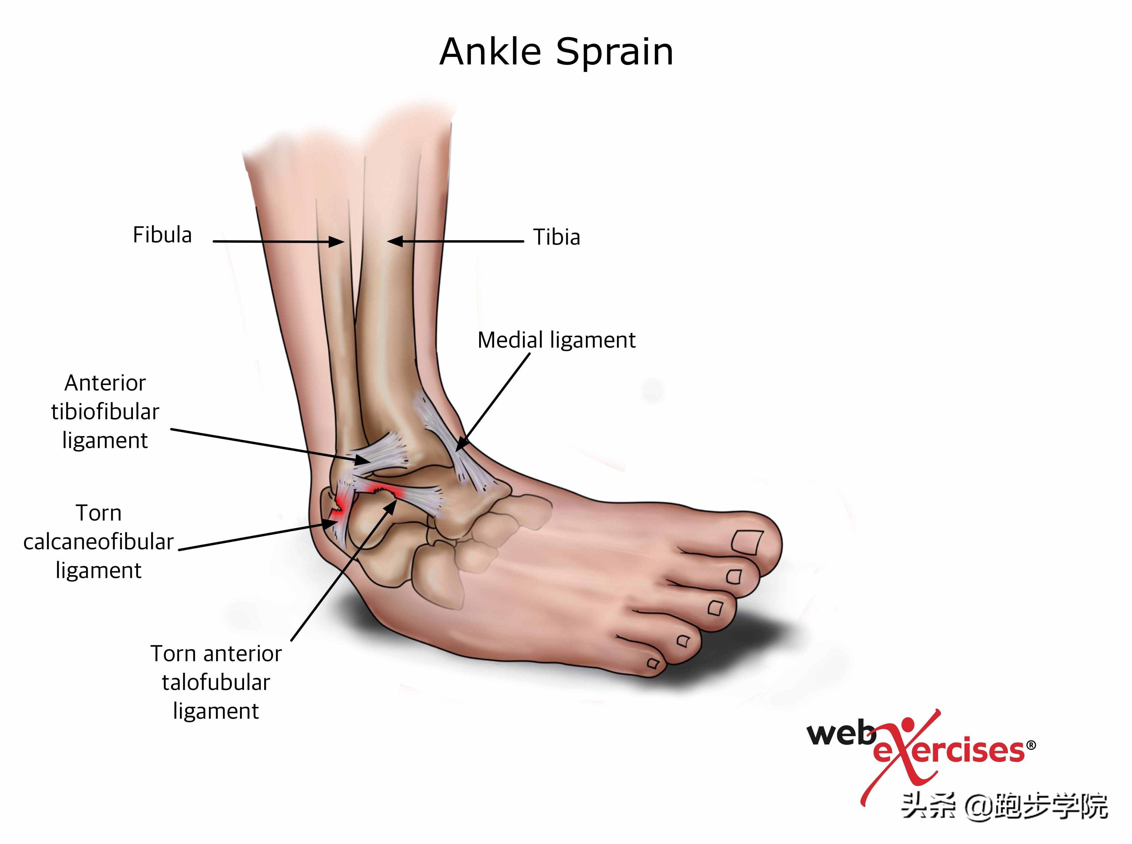關(guān)于腳踝扭傷的所有干貨，都在這了