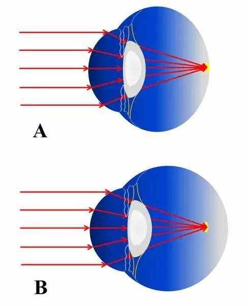近視是怎樣形成的？