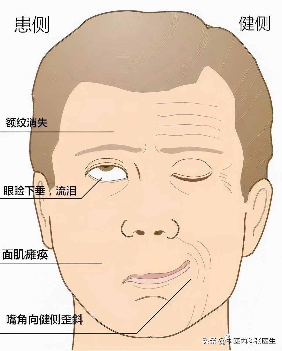 除了口歪眼斜，面癱還會(huì)有哪些表現(xiàn)？會(huì)有哪些后遺癥？