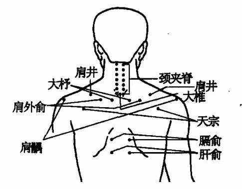 拔火罐能治療頸椎病，為家人收藏起來！