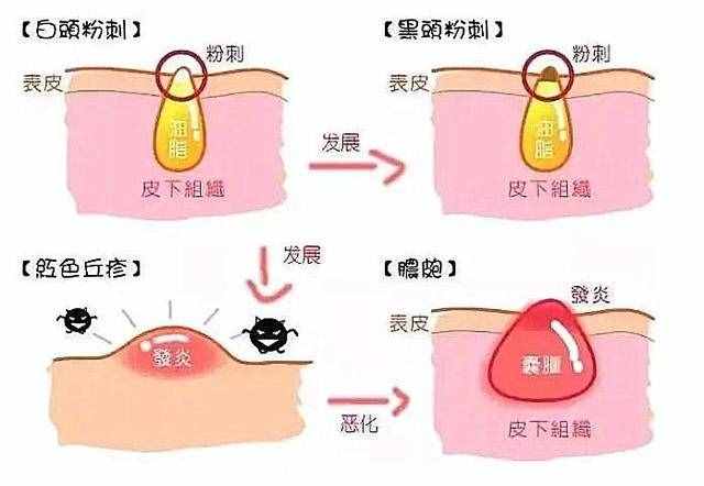 什么是閉口粉刺？為什么會(huì)長閉口？如何有效去閉口