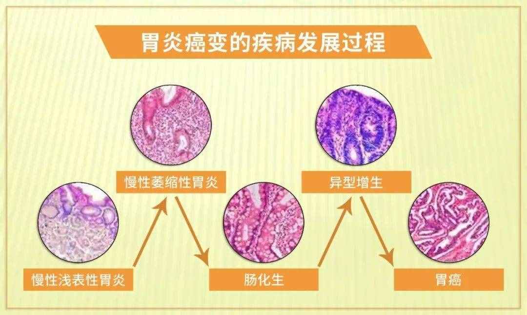 胃病都有哪些，什么癥狀