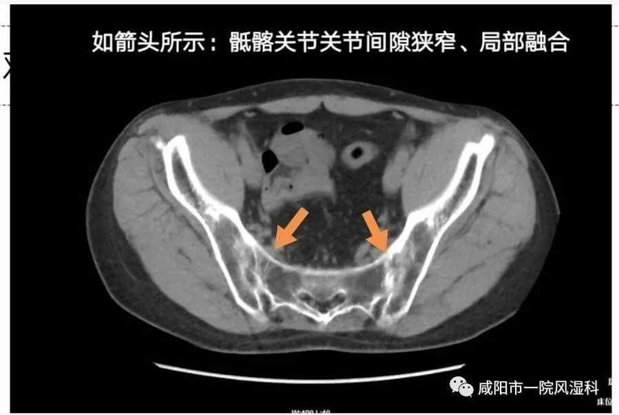 咸陽(yáng)市第一人民醫(yī)院："不死的癌癥"——強(qiáng)直性脊柱炎20年抗?fàn)幱?class=