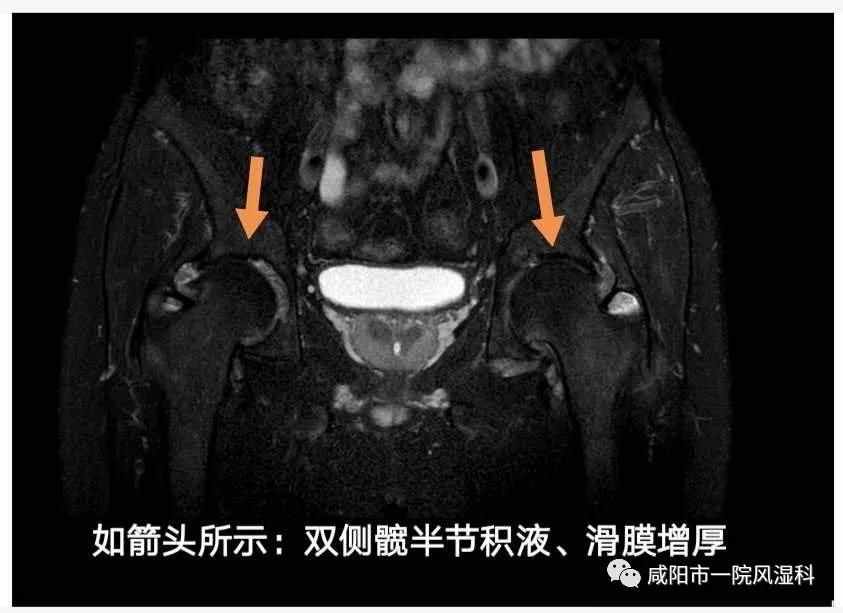 咸陽(yáng)市第一人民醫(yī)院："不死的癌癥"——強(qiáng)直性脊柱炎20年抗?fàn)幱?class=