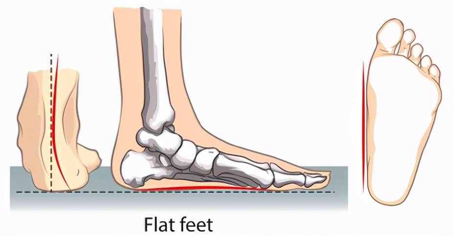 扁平足——有一種痛叫做“腳踏實(shí)地”的痛