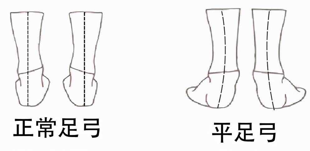 扁平足——有一種痛叫做“腳踏實(shí)地”的痛