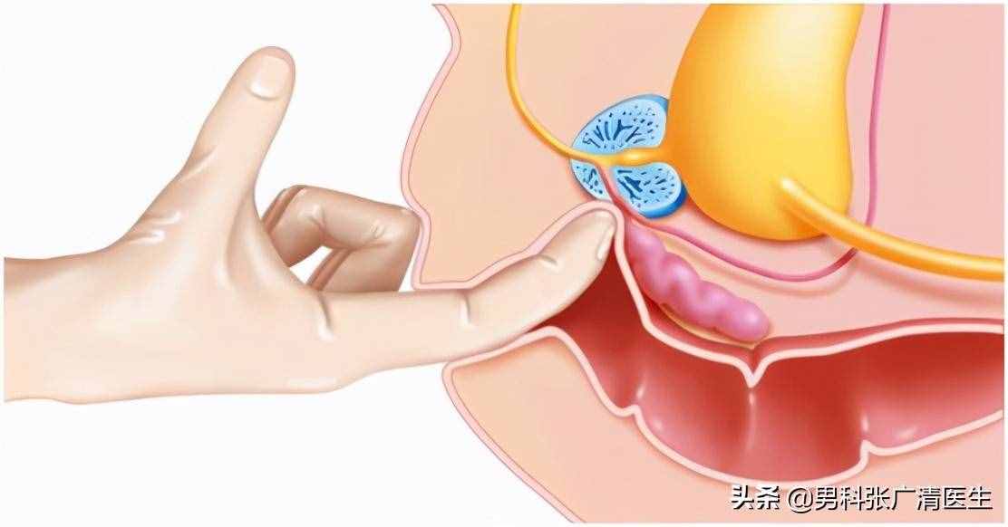 前列腺的“爆菊花”指檢法